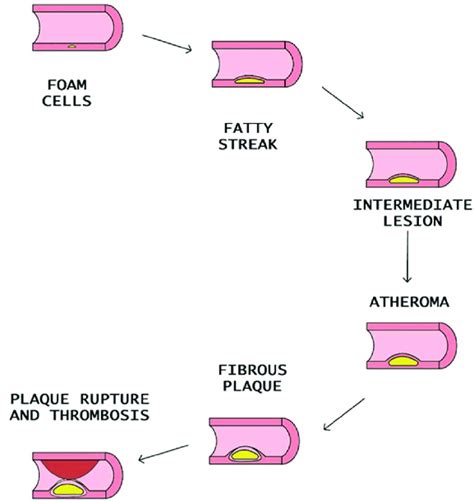 Steps of atheromatous plaque formation, progression, and rupture ...