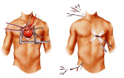 Image On The Left Exhibits An Orthodox Open Heart Surgery Whereas