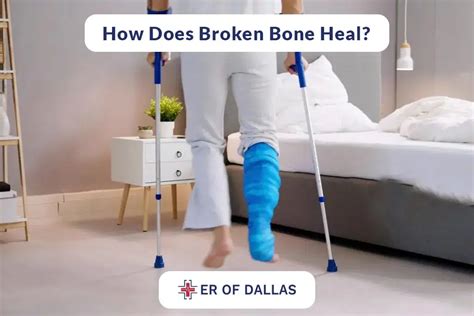 Broken Bones Fractures Types Causes Symptoms And Treatment Er