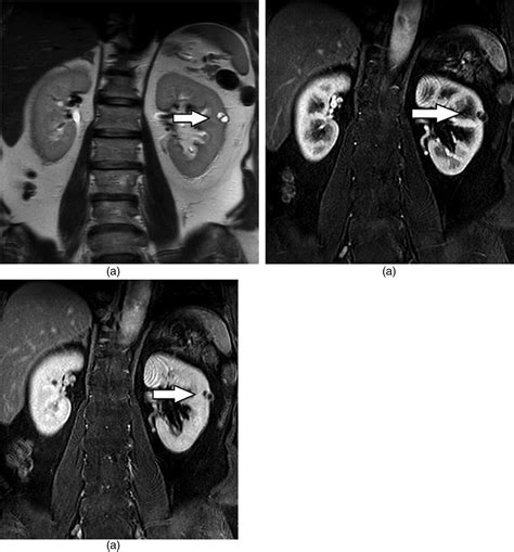 Cross Sectional Imaging Assessment Of Renal Masses With 46 OFF