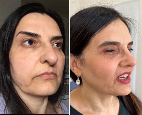 Endolift Non Surgical Laser Face Lift Dr Deniz Kanliada Plastic