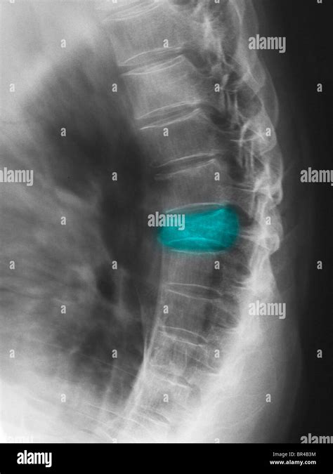 Spinal Fracture X Ray