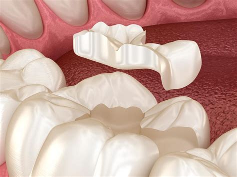 Ceramic Onlays And Inlays Wainui Dental Hutt Prosthetic Dentist