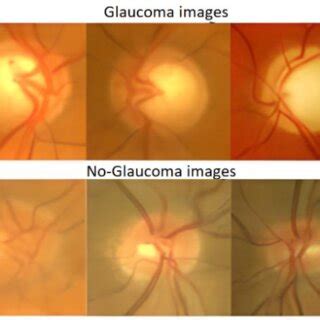 Pdf Deep Learning For Glaucoma Detection R Cnn Resnet And Image