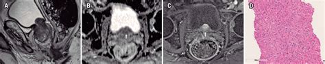 Scielo Brasil Multiparametric Magnetic Resonance Imaging Findings