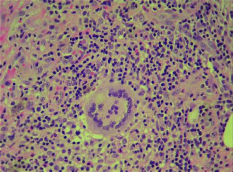 Biopsy Demonstrating A Granulomatous Reaction In A Multinucleated Giant