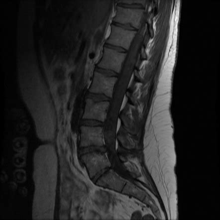 Multiple Cauda Equina Schwannomas In Neurofibromatosis Type