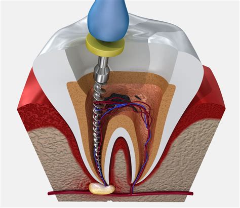 What Is Root Canal Surgery Like At Anne Mengel Blog