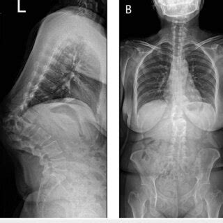 Preoperative A And Postoperative B Lateral Whole Spine Radiography