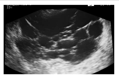 Figure 1 From Benign Multicystic Peritoneal Mesothelioma Semantic