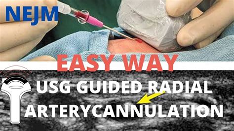 Usg Guided Radial Artery Cannulation A Different Approach Nejm Tutorial Youtube