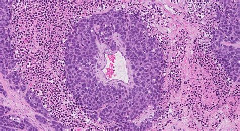 Large Cell Neuroendocrine Carcinoma Of The Lung Atlas Of Pathology