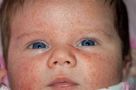 Understanding Common Newborn Rashes A Paediatricians Guide For Parents