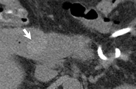 Ct For Evaluation Of Acute Gastrointestinal Bleeding Radiographics