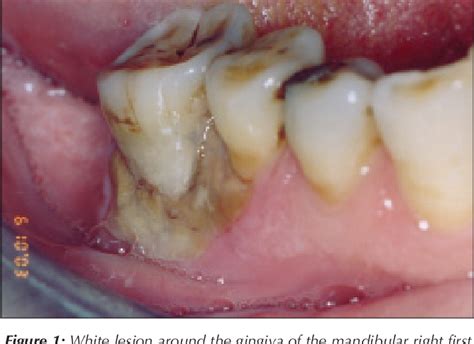 Figure 1 From Necrosis Of Gingiva And Alveolar Bone Caused By Acid