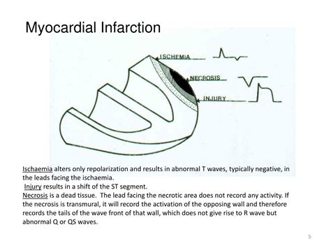 Ppt Electrocardiogram Ecg Iii Powerpoint Presentation Free Download