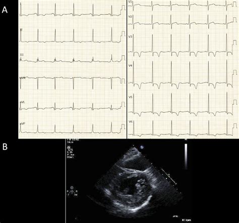 Figure4 Twelve Lead Electrocardiogram ECG A And Transthoracic