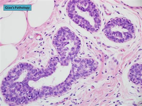 Qiao's Pathology: Flat Epithelial Atypia of the Breast | Flickr