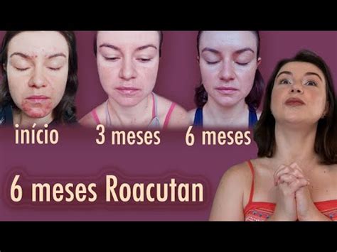 6 meses de Roacutan Minha experiência Opinião de Esteticista roacutan