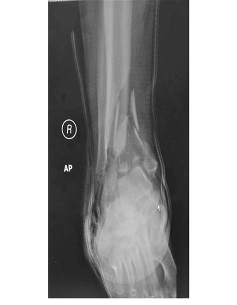 Ap Radiograph Shows Both The Comminuted Pilon Fracture And Calcaneal