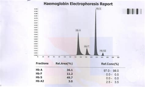 HEMOGLOBLIN ELECTROPHORESIS