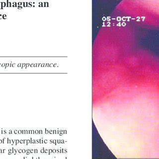 (PDF) Glycogenic acanthosis of the esophagus: An unusually endoscopic ...