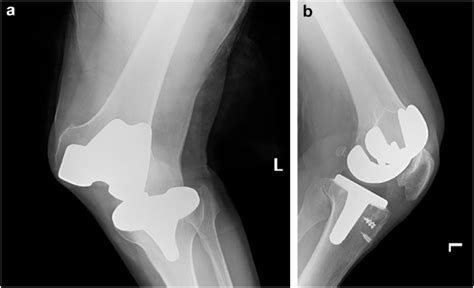 Anteroposterior A And Lateral B Radiographs Demonstrating A Left