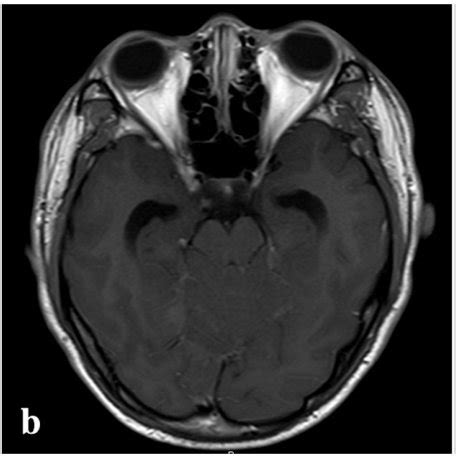 Post Gadolinium T Weighted Magnetic Resonance Imaging Showing The