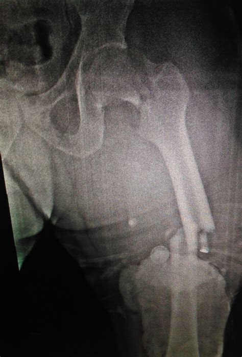 Right Femoral Neck Fracture