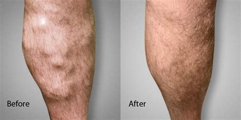 Before And After Photos L Advanced Varicose Vein Treatments Of Manhattan Nyc