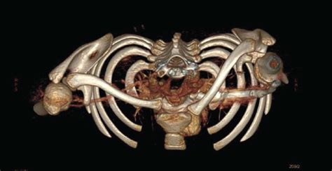 Axial A And Three Dimensional Reconstructed B Computed Tomography Download Scientific