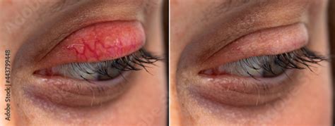 Human Eye Upper Eyelid Chalazion Before And After Side By Side