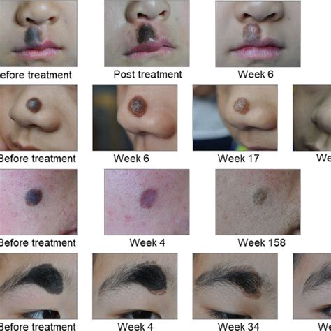 Congenital Melanocytic Nevus Cmn Clinical Appearance Before Week