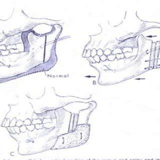 Ramus osteotomy Preservation of soft Tissue coverage | Download ...