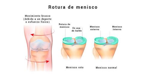 Rotura De Menisco S Ntomas Causas Y Rehabilitaci N Fisio For All