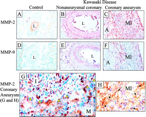 Systemic Arterial Expression Of Matrix Metalloproteinases 2 And 9 In