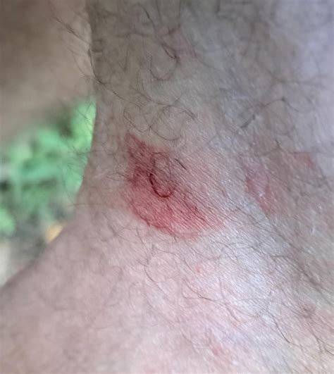 Does This Look Like A Tick Bite Rbackyardwildlife