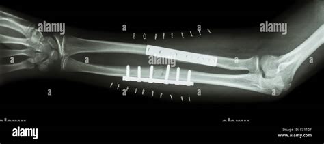 Hueso De Fractura Fotografías E Imágenes De Alta Resolución Página 3