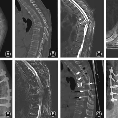 A Yearold Female Patient With T Spinal Tuberculosis Received A