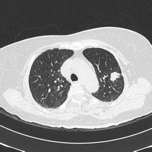 CP Advanced Imaging | Low Dose CT Lung Screening