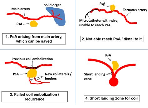 Figure 1 From Endovascular Embolization Of Visceral Artery