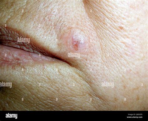 Basal cell carcinoma Stock Photo - Alamy