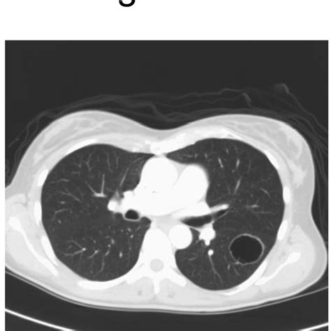 A. Pre-therapy CT scan of chest B. Post-therapy CT scan of chest ...