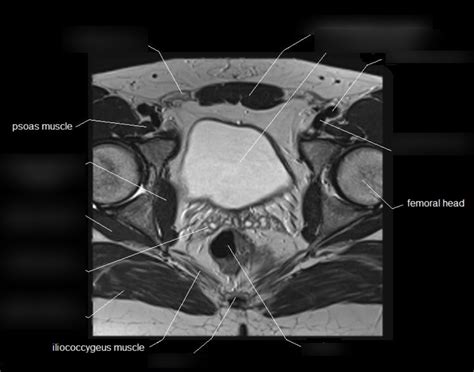 Male Pelvis Mri 1 Diagram Quizlet