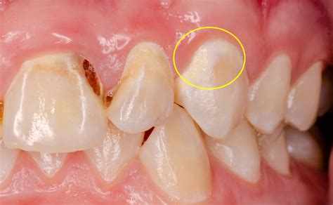 虫歯を確かめる方法（画像あり）と虫歯を見つけた時の対策について 西田辺阿倍野区の歯医者 歯周病｜西田辺えがしら歯科