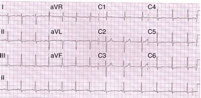 Late Complications after the Arterial Switch Operation | Thoracic Key