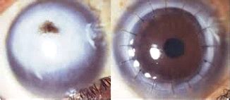 Cornea