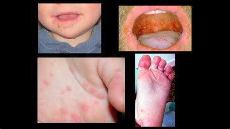 Hand Foot Mouth Disease Youtube