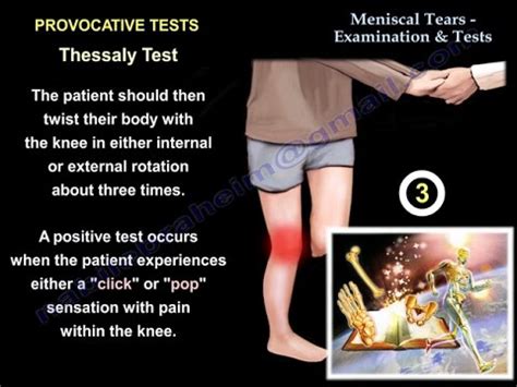 Lateral Meniscus Tear Symptoms