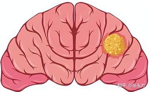 良性肿瘤和恶性肿瘤到底有哪些不同？恶性脑肿瘤还有必要做手术吗 知乎